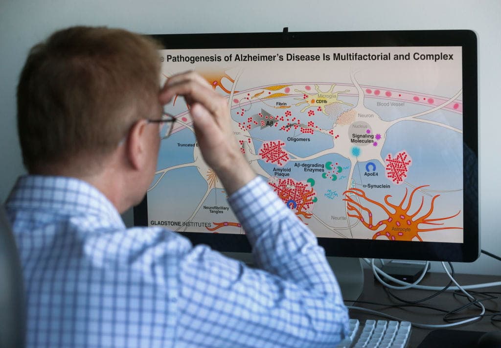 High on Health: A New Early Warning Sign for Alzheimer’s 